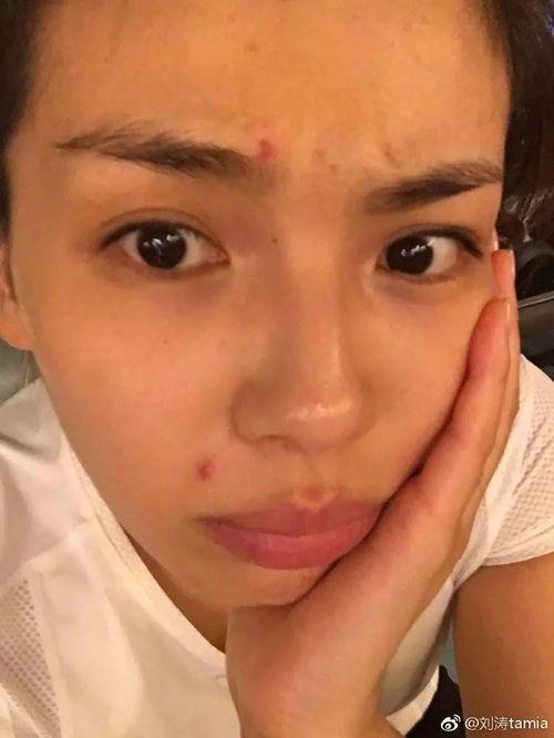 长痘的女明星,揭秘长痘女明星的护肤逆袭之路